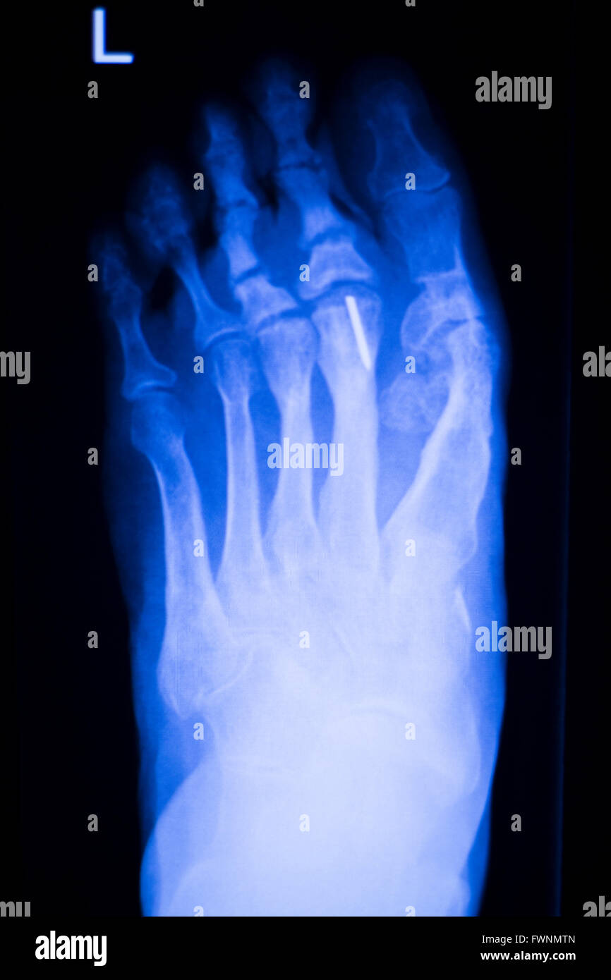 Foot and toes medical x-ray test scan result for adult showing orthopedic Traumatology titanium metal plate implant image. Stock Photo