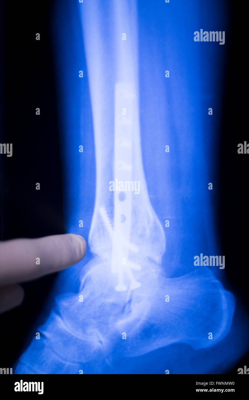 Foot, ankle and leg medical x-ray test scan result for adult showing orthopedic Traumatology titanium metal plate implant image. Stock Photo