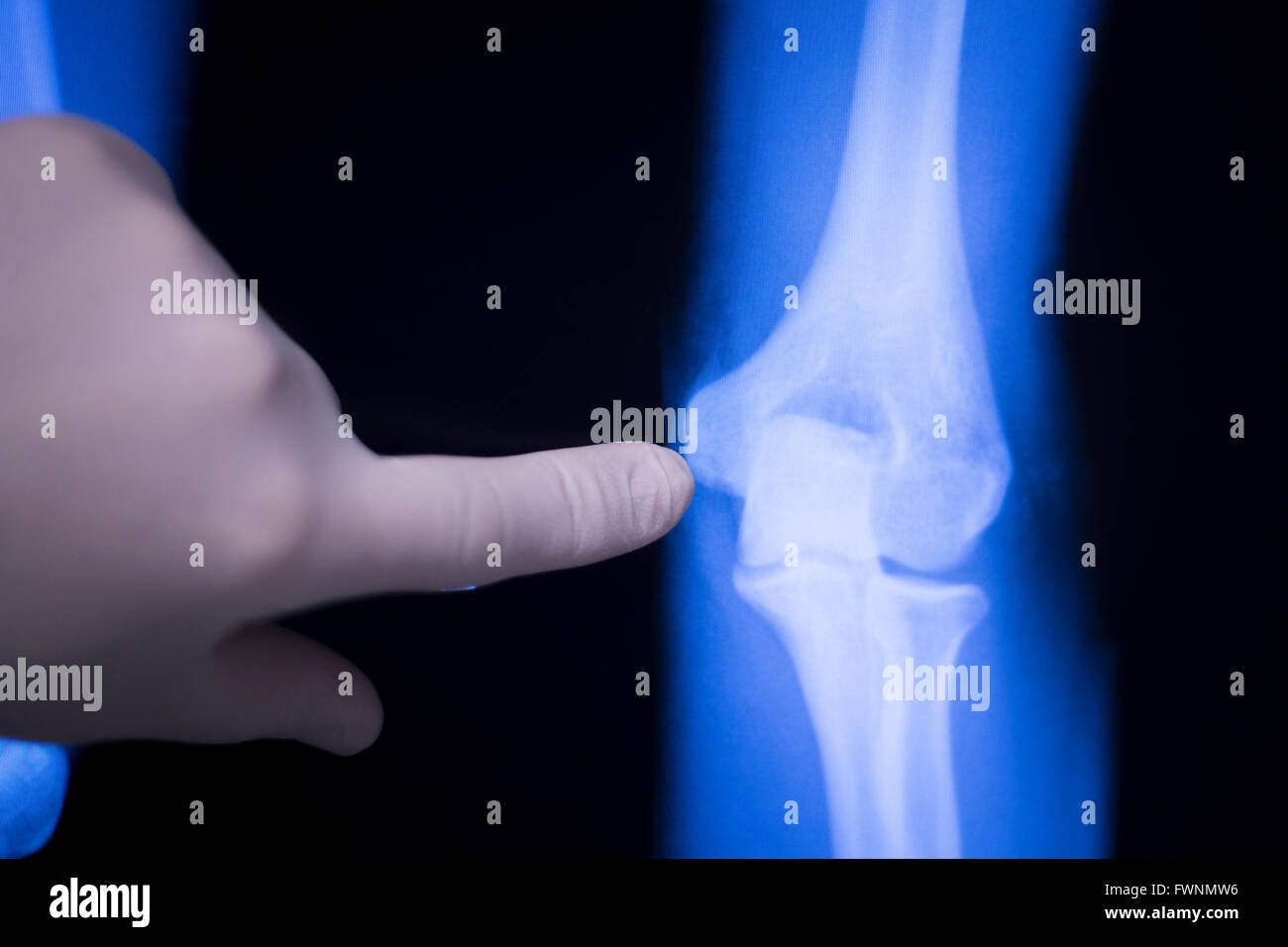 Elbow, forearm and arm joint medical xray test scan result for senior