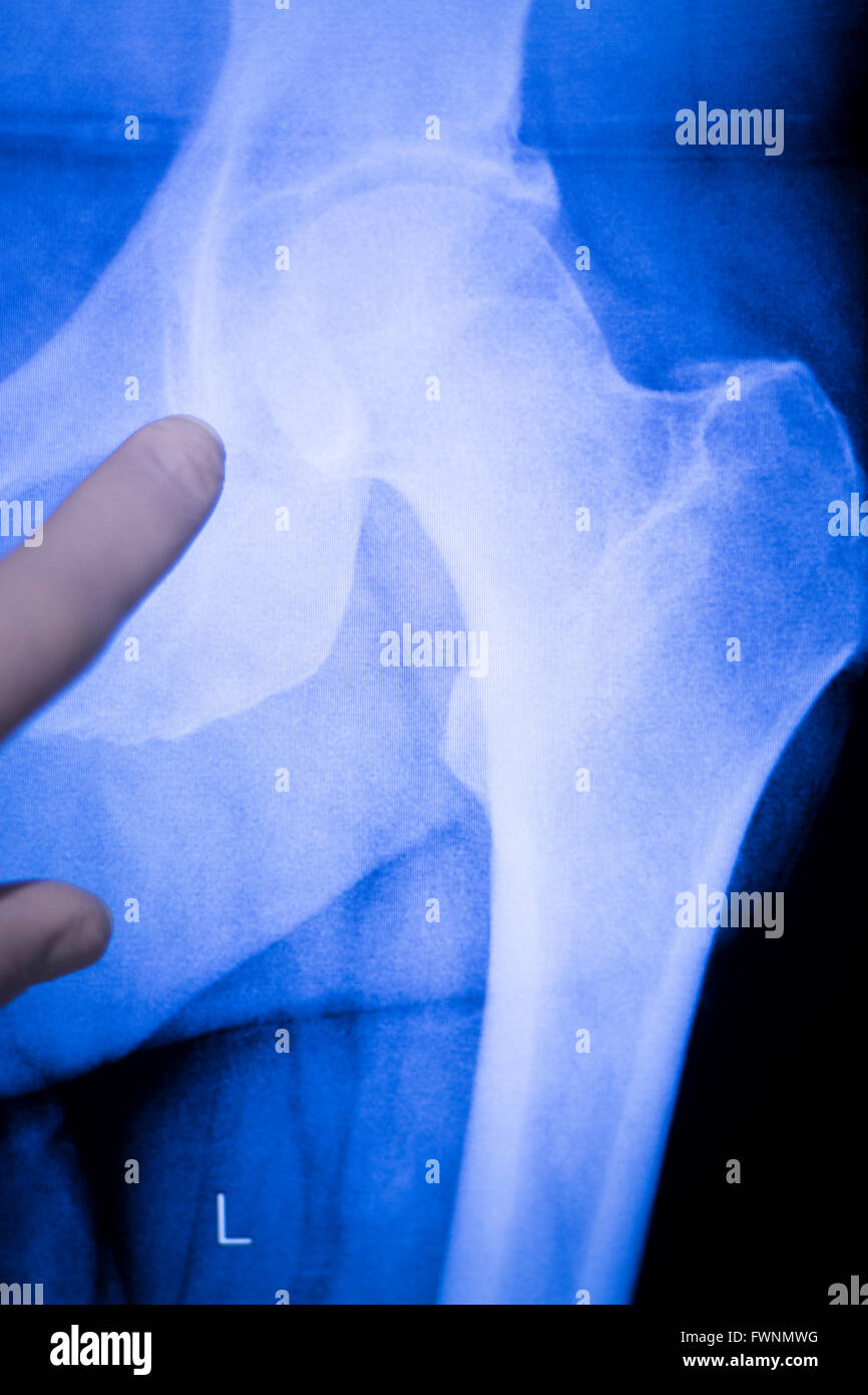 Hip joint medical xray test scan result for senior adult patient with