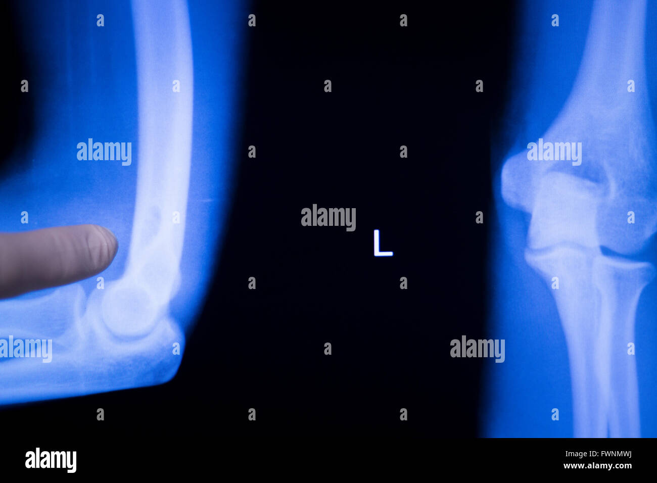 Elbow, forearm and arm joint medical xray test scan result for senior