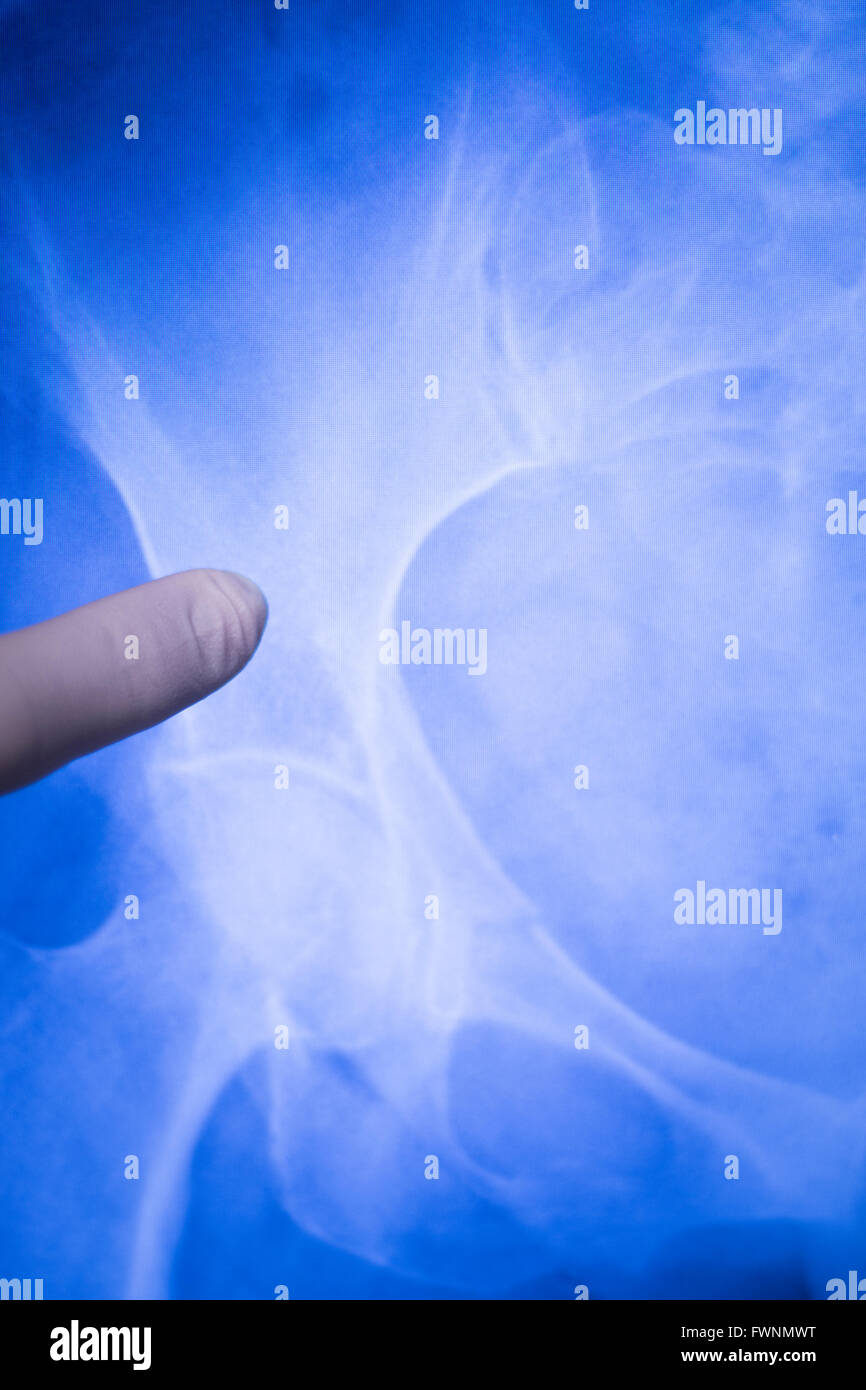 Hip joint medical xray test scan result for senior adult patient with