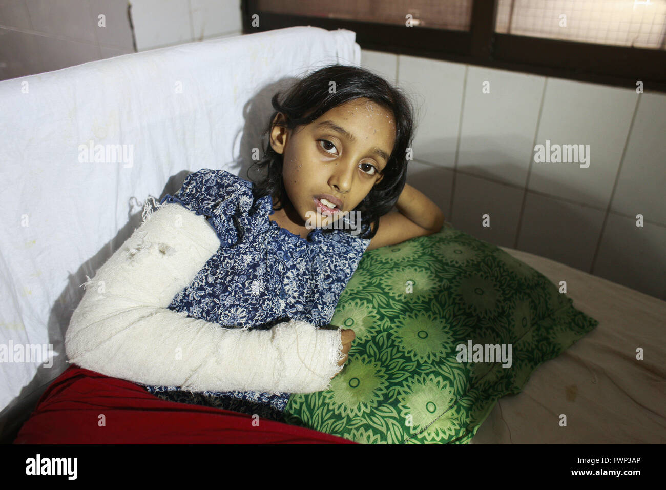 Dhaka, Bangladesh. 7th Apr, 2016. Acid attack victim Sanjida Sultana Reema, 9, lays on a hospital bad in Dhaka, Bangladesh, April 7, 2016. Unidentified miscreants splashed a family with deadly acid at Dhaka's Mirpur, leaving four including three women badly burnt. The victims were rushed to the Burn Unit of the Dhaka Medical College Hospital (DMCH) after the early morning acid attack on Thursday, said police. Credit:  ZUMA Press, Inc./Alamy Live News Stock Photo