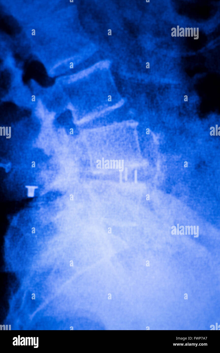 Spinal column, vertebra and back patient medical x-ray test scan result for adult showing orthopedic Traumatology titanium metal plate implant back pain image. Stock Photo