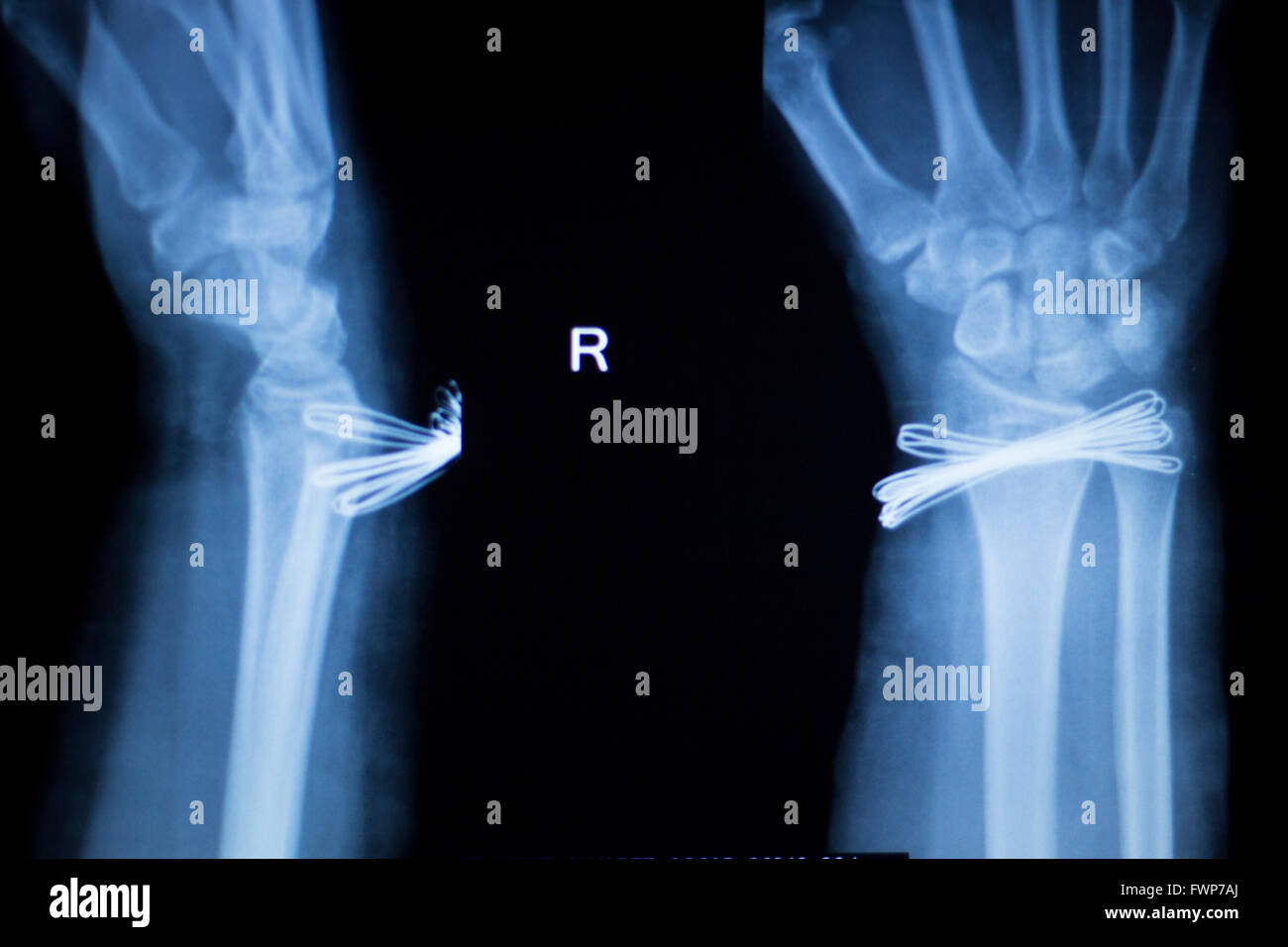 Wrist Hand Forearm And Arm Injury Medical X Ray Test Scan Result For