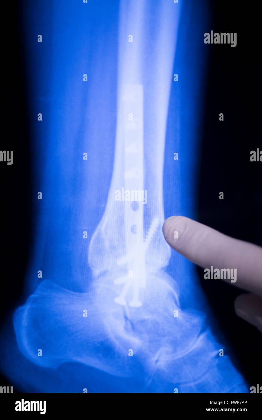 Foot, ankle and leg medical x-ray test scan result for adult showing orthopedic Traumatology titanium metal plate implant image. Stock Photo