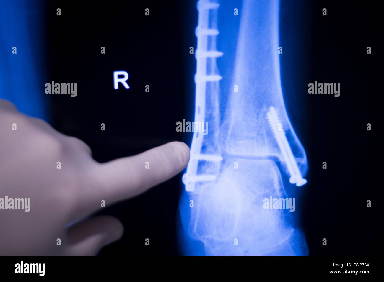 Foot, ankle and leg medical x-ray test scan result for adult showing orthopedic Traumatology titanium metal plate implant image. Stock Photo