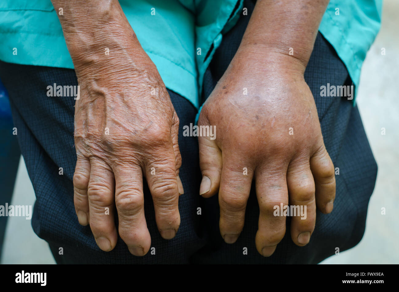 left hand inflammation from the green pit viperb snake bite Stock Photo