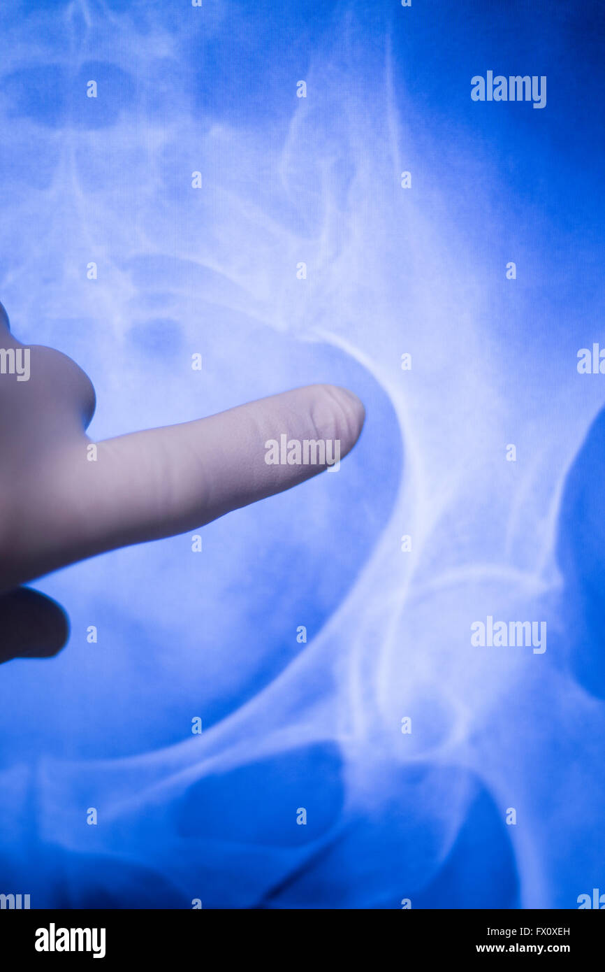 Hip joint medical xray test scan result for senior adult patient with