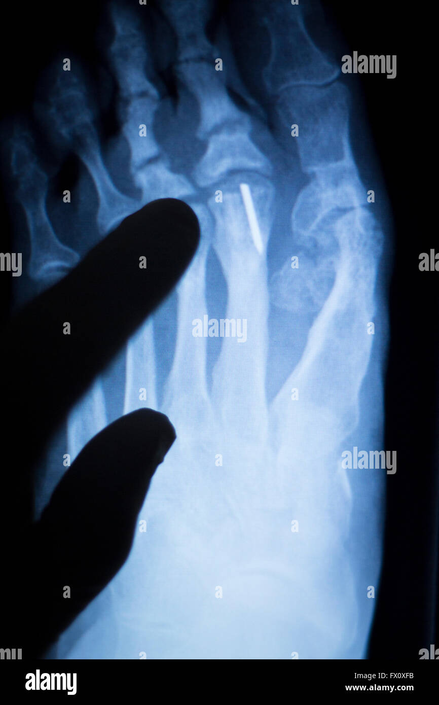 Foot and toes medical x-ray test scan result for adult showing orthopedic Traumatology titanium metal plate implant image. Stock Photo