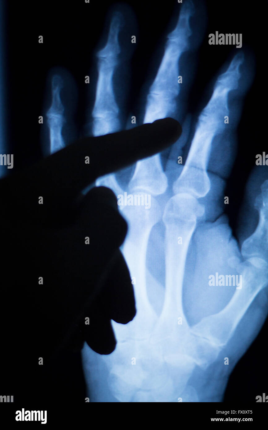 Wrist, hand injury medical xray test scan result for adult image Stock