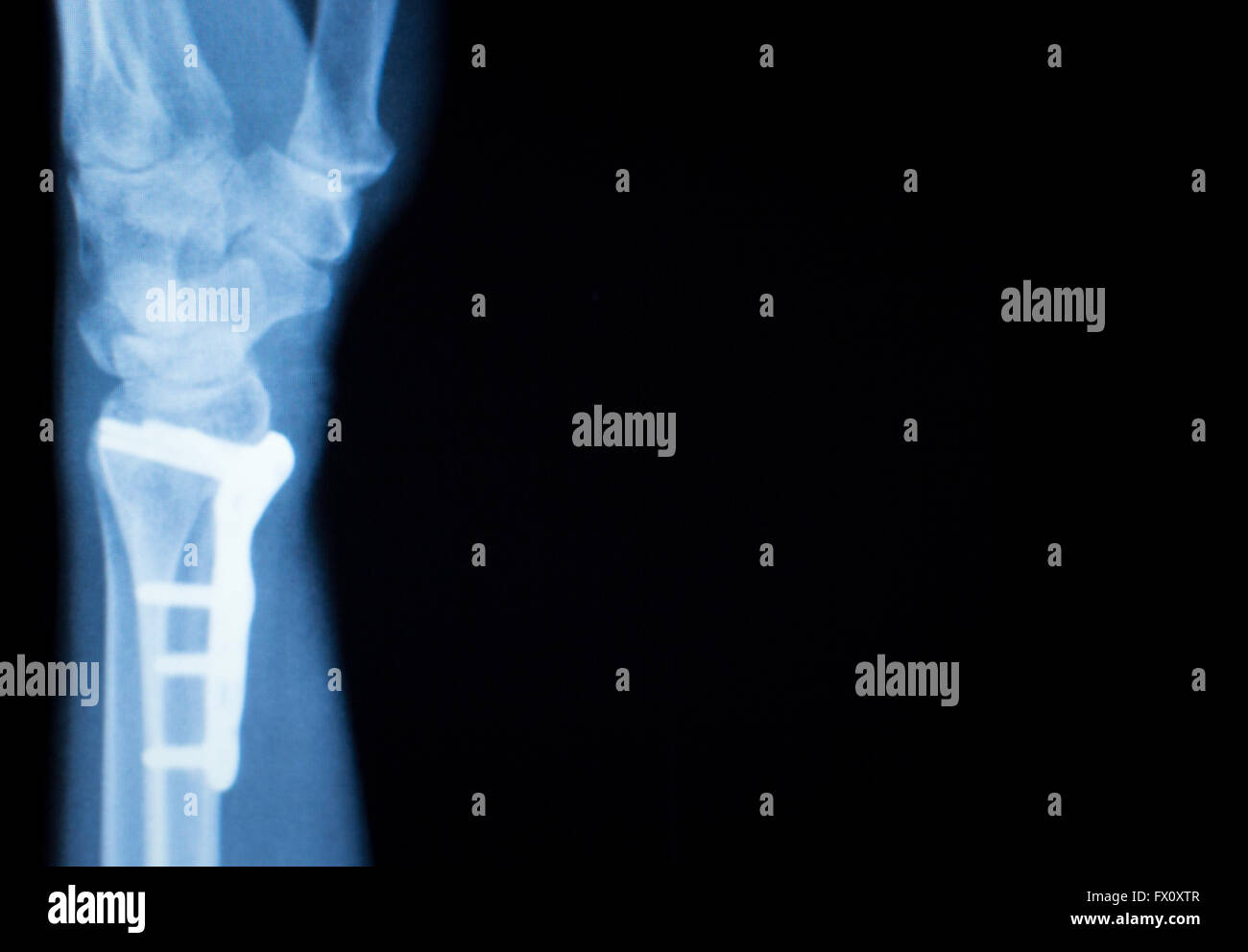 Wrist, hand, forearm and arm injury medical xray test scan result for