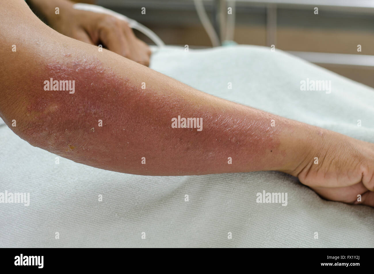 Arm of patient allergic to herbicide Stock Photo