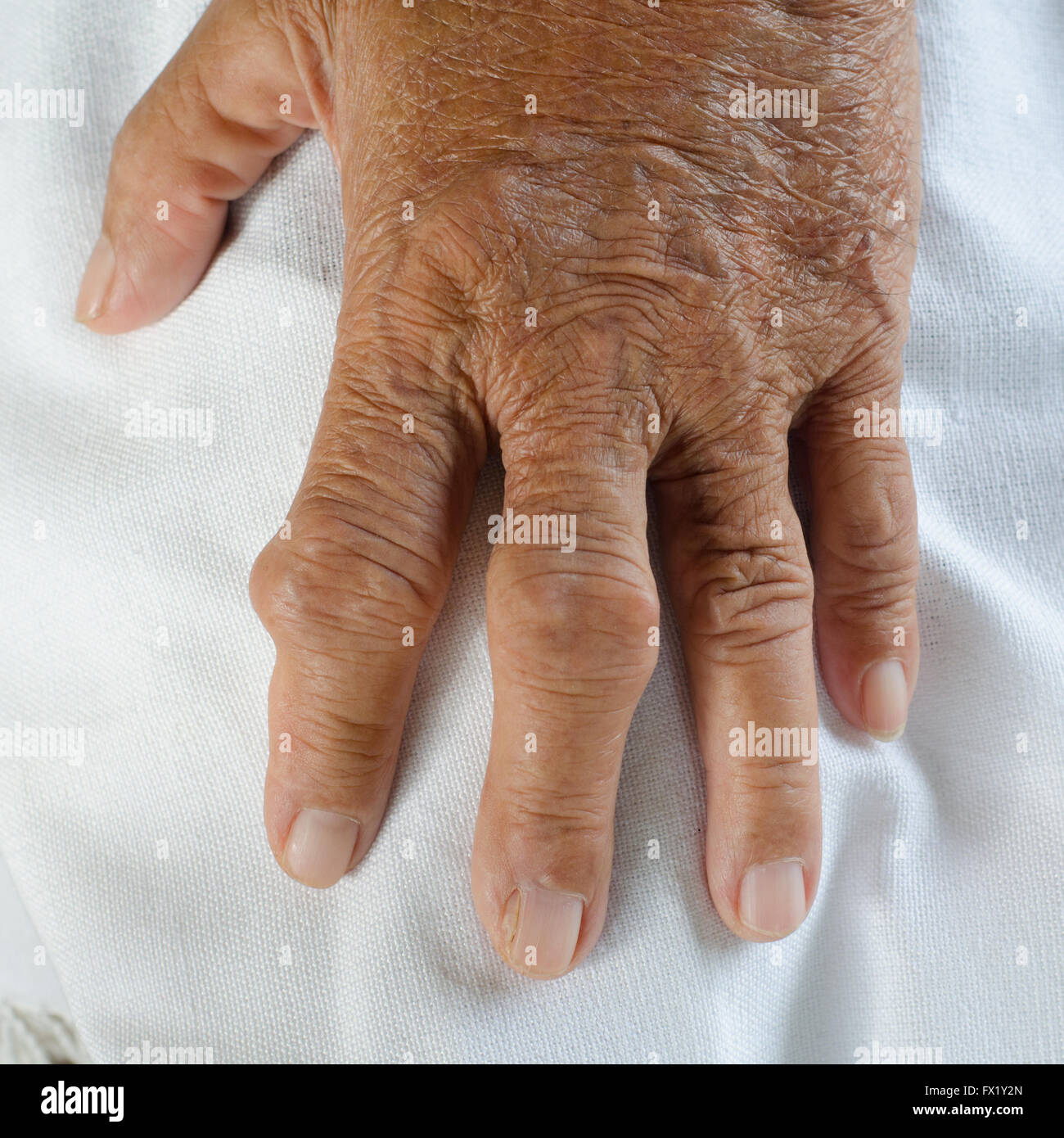 Fingers of patients with gout. Stock Photo