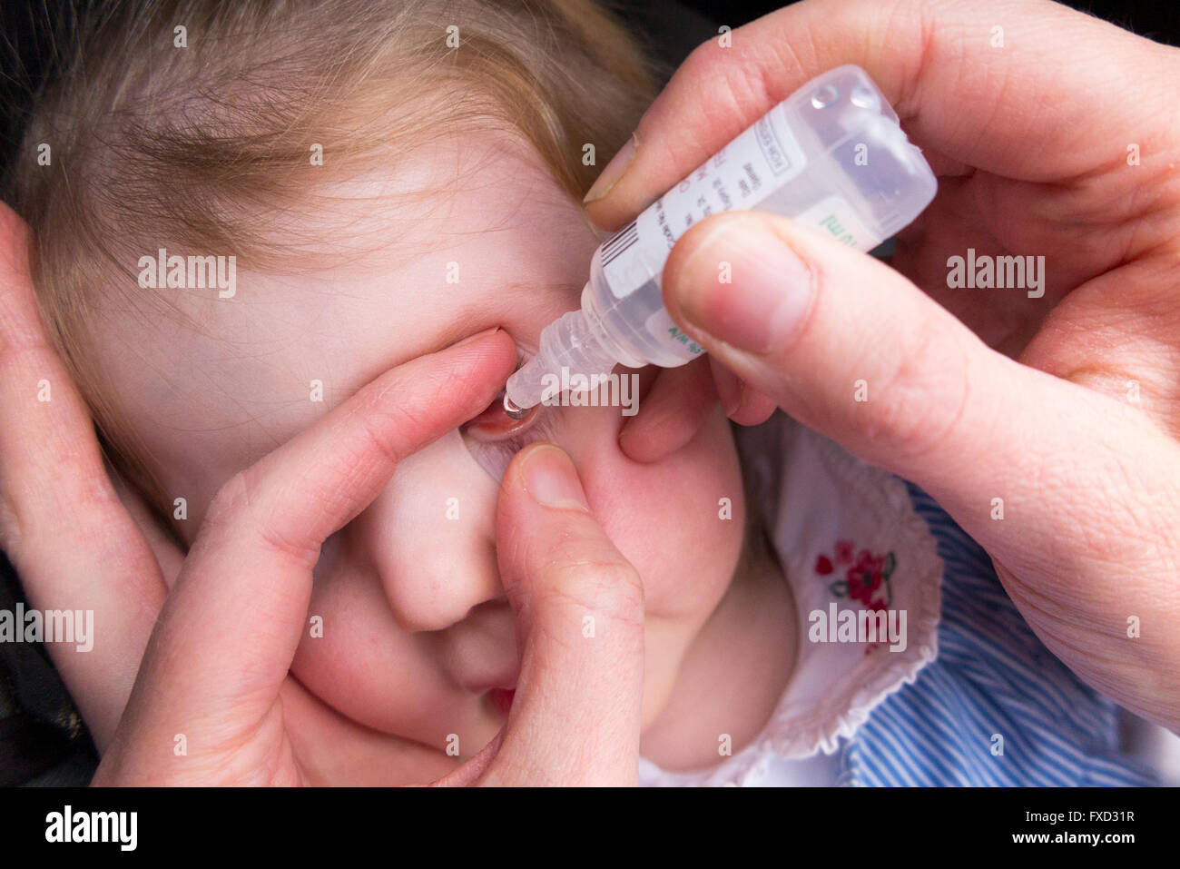 20 Month old child / kid toddler baby with  conjunctivitis being given antibiotic eye drops drop by her mum / mother Stock Photo