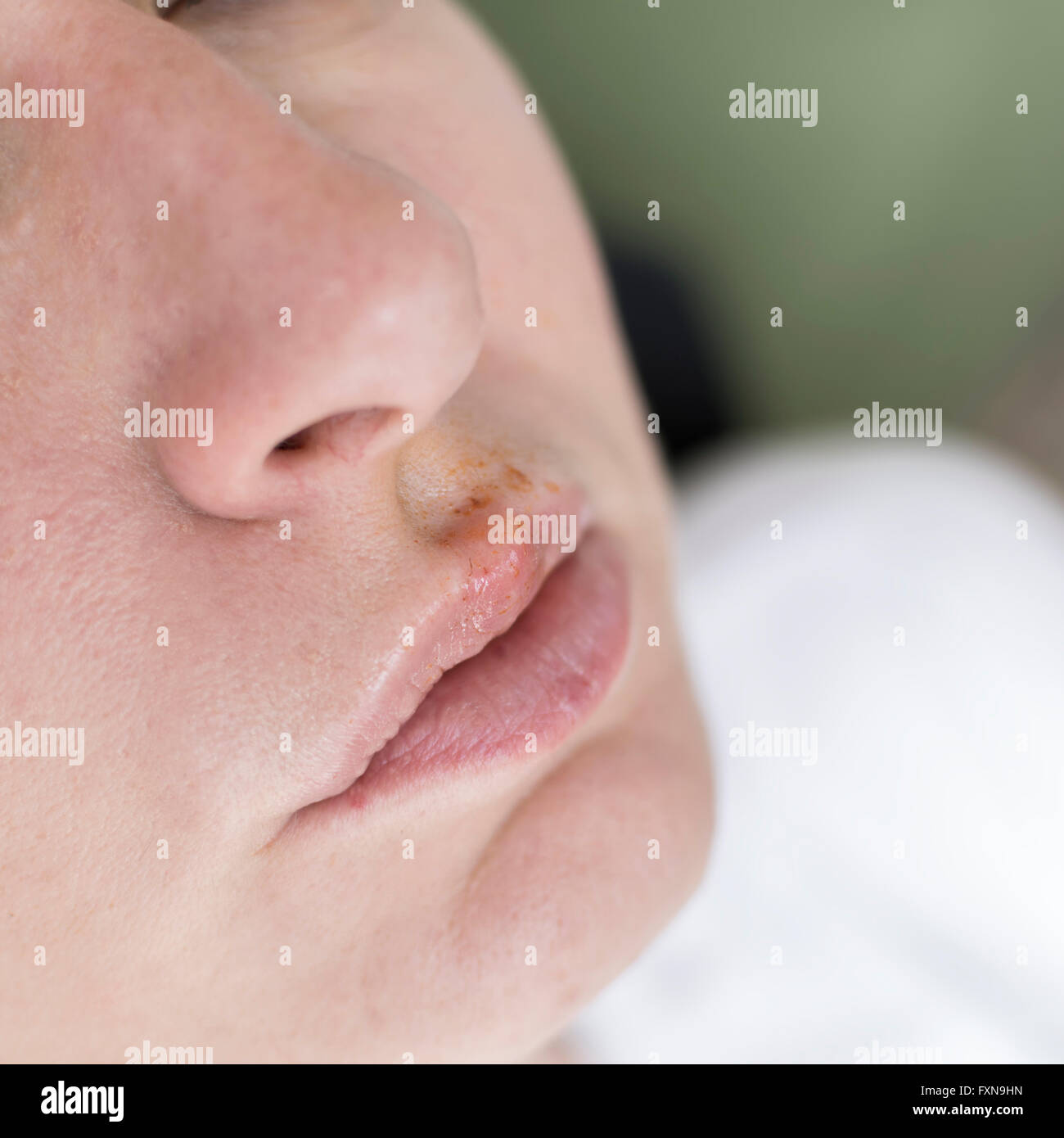 Herpes on the lips of the young woman, close up Stock Photo