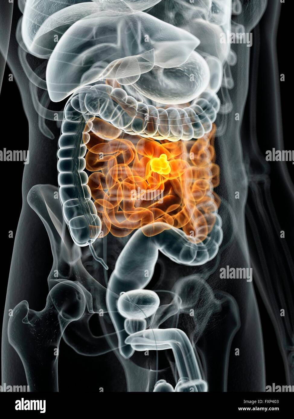 Human bowel cancer, computer illustration. Stock Photo