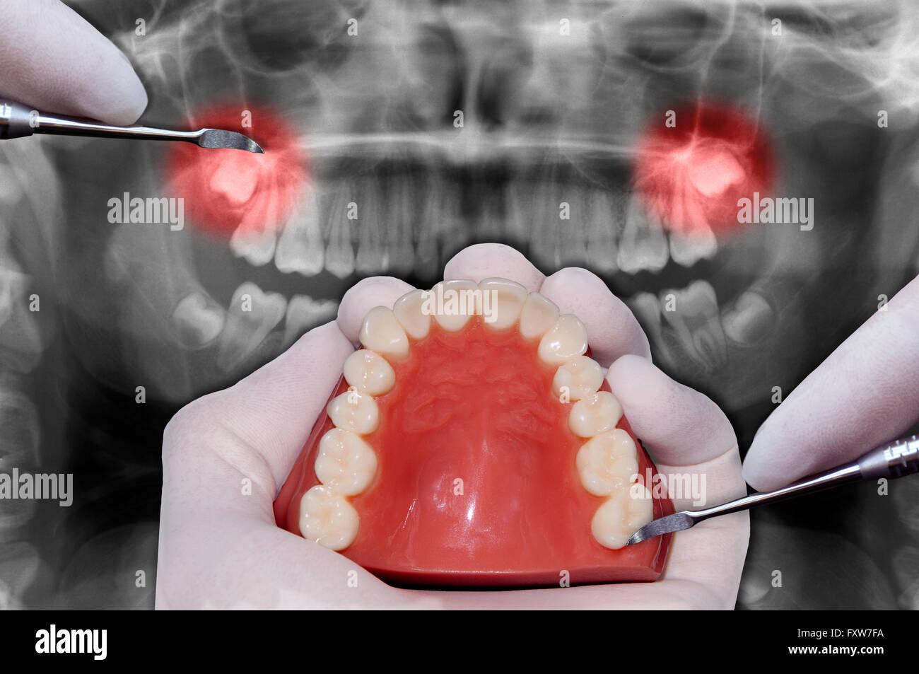 dentist hand simulates dental surgery wisdom teeth Stock Photo