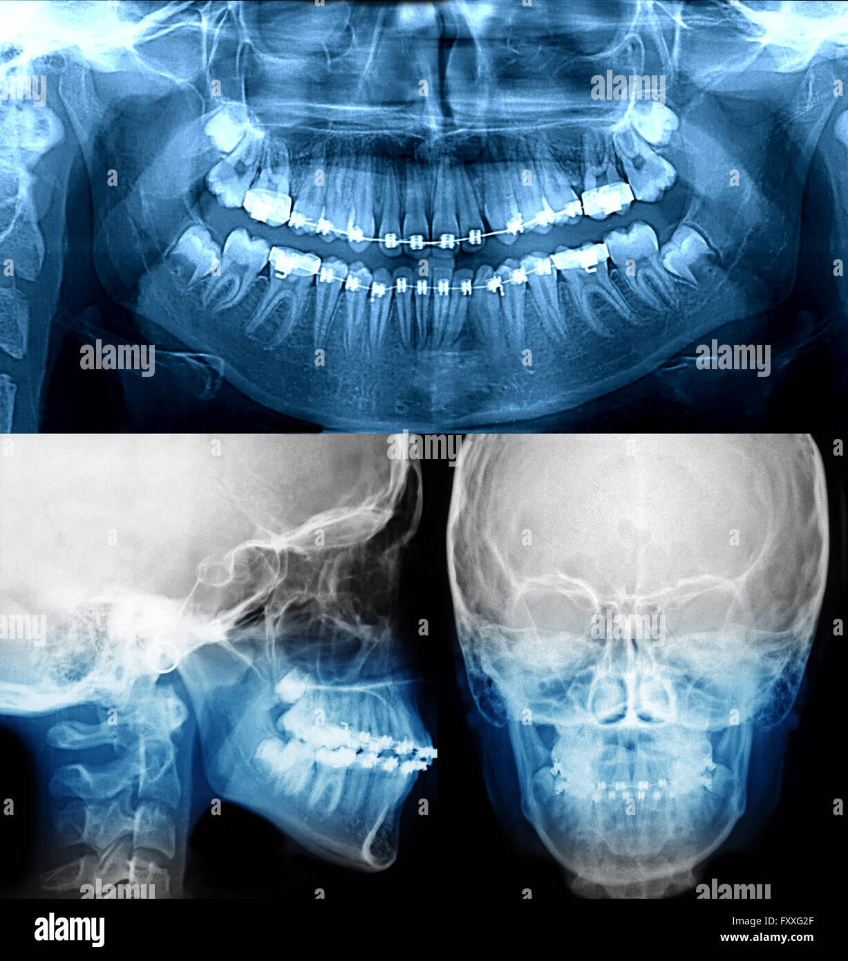 dental xray with braces fixed appliance orthodontic care Stock Photo
