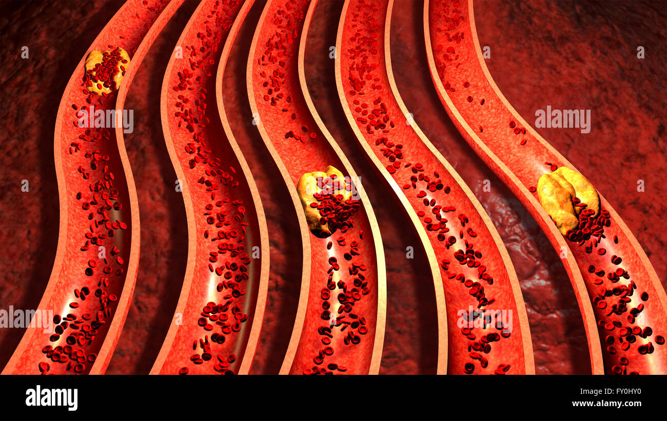 Clogged Artery with platelets and cholesterol plaque. Atherosclerosis