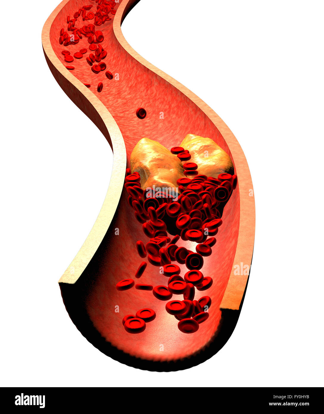 Clogged Artery with platelets and cholesterol plaque. Atherosclerosis
