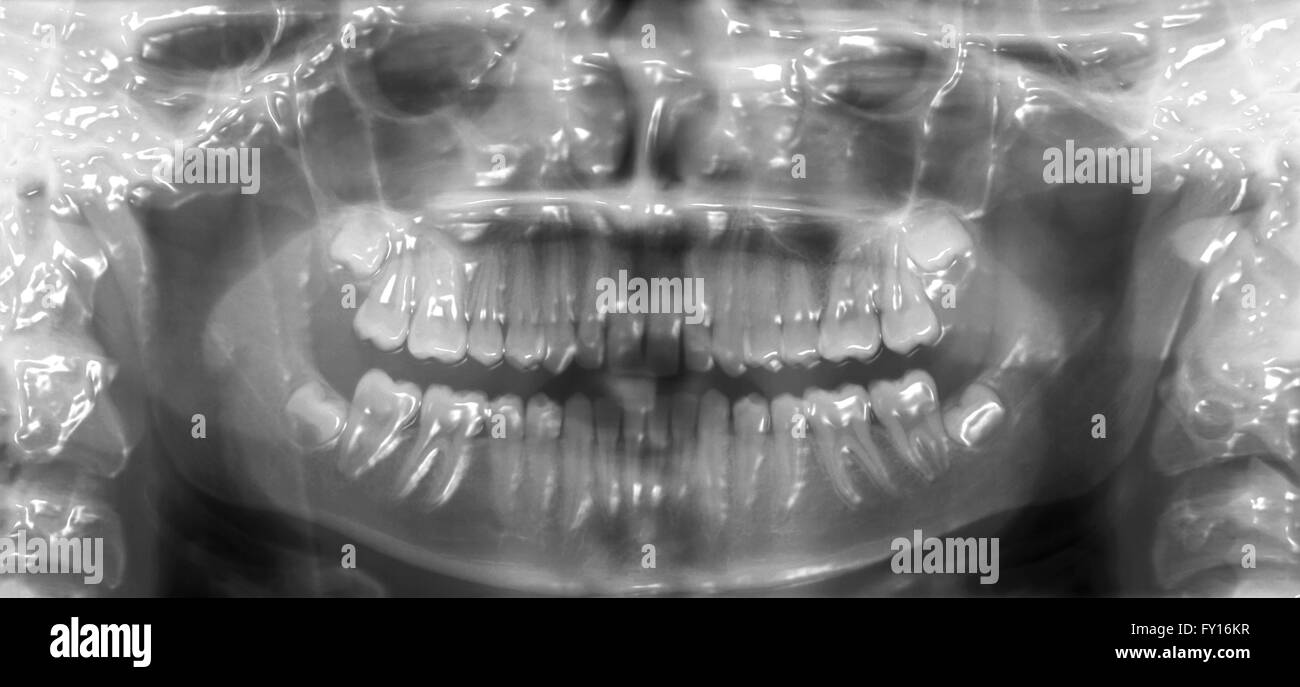 digital 3d dental scan technology Stock Photo