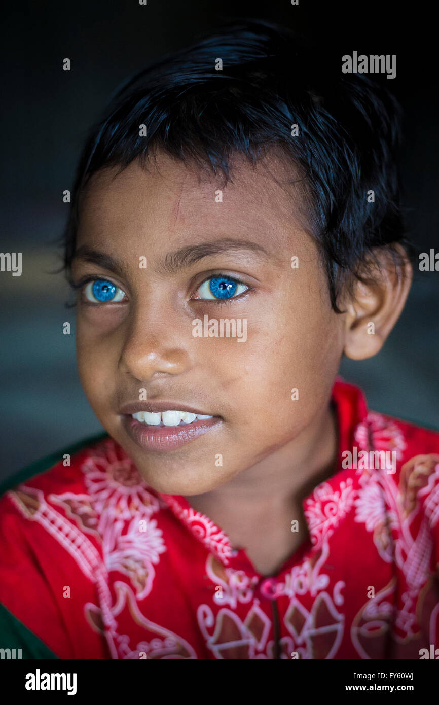 Dhaka, Bangladesh. 21th Apr, 2016. Rizvi 8 Years old, a child with rare