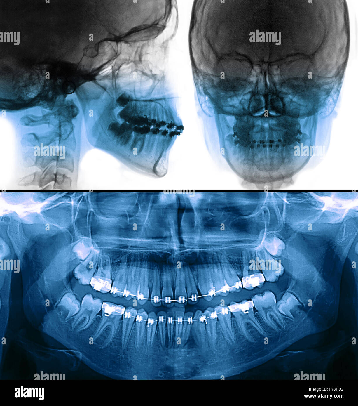 Dental panoramic x ray hires stock photography and images Alamy