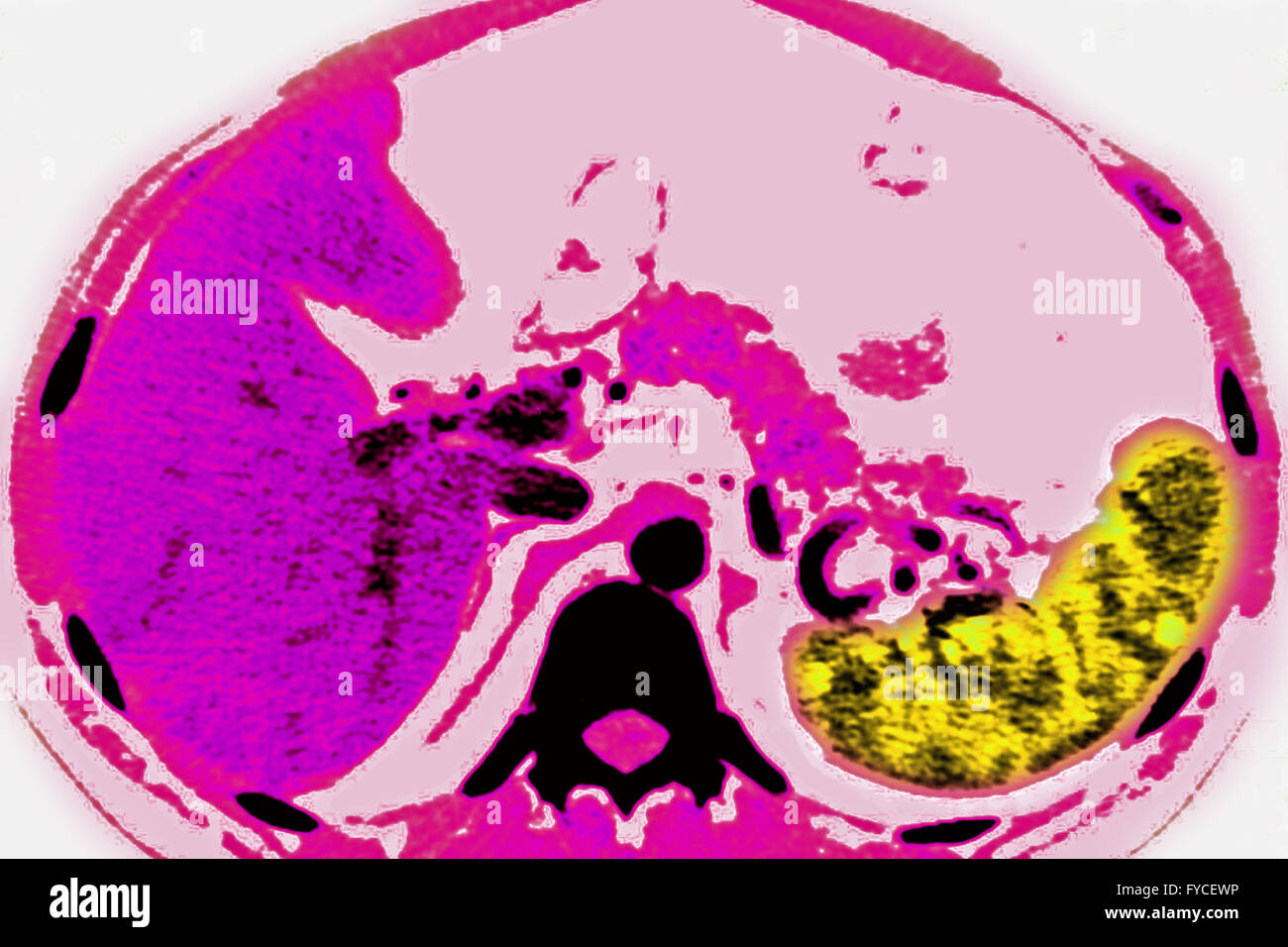 ADENOPATHY SCAN Stock Photo Alamy