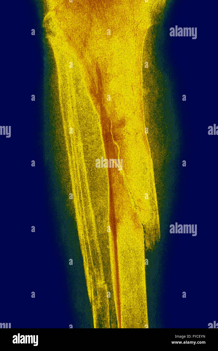 FRACTURED LEG, XRAY Stock Photo Alamy
