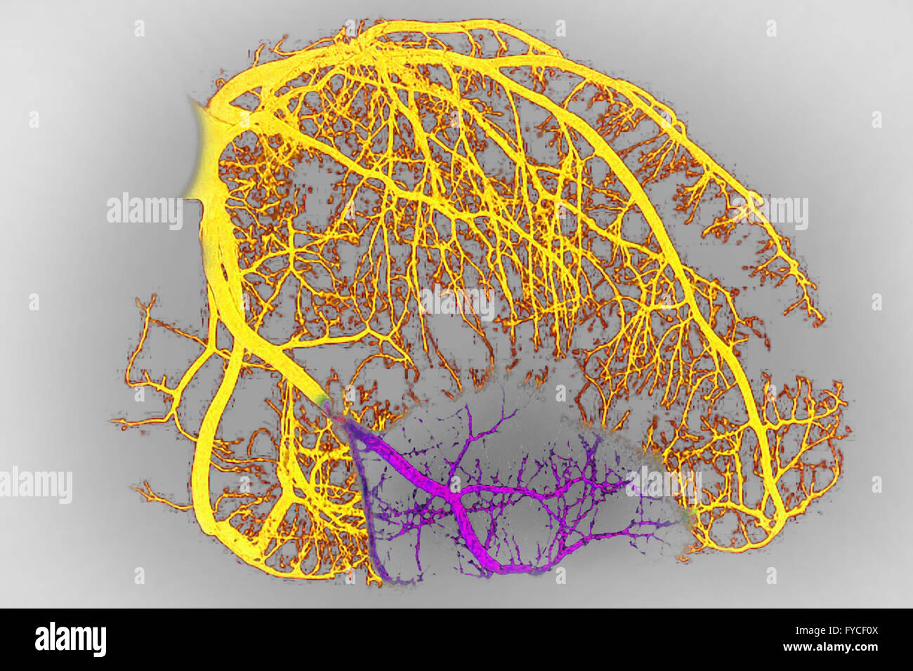 Infarctus Rouge MYOCARDIAL INFARCTION, ILLUSTRATION Stock Photo - Alamy