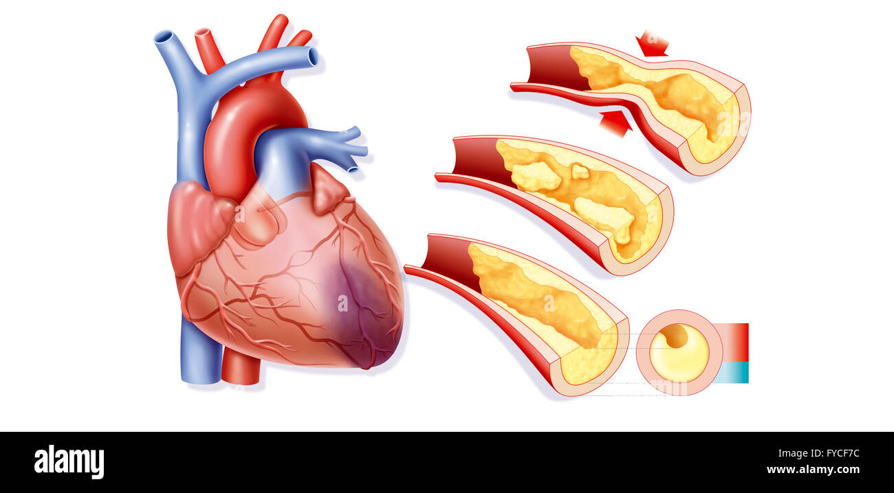 HEART ATTACK, DRAWING Stock Photo