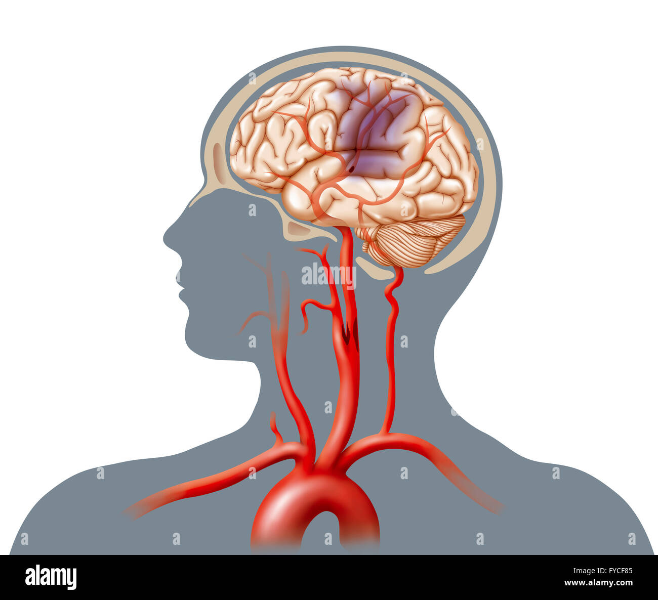 CEREBROVASCULAR ACCIDENT Stock Photo