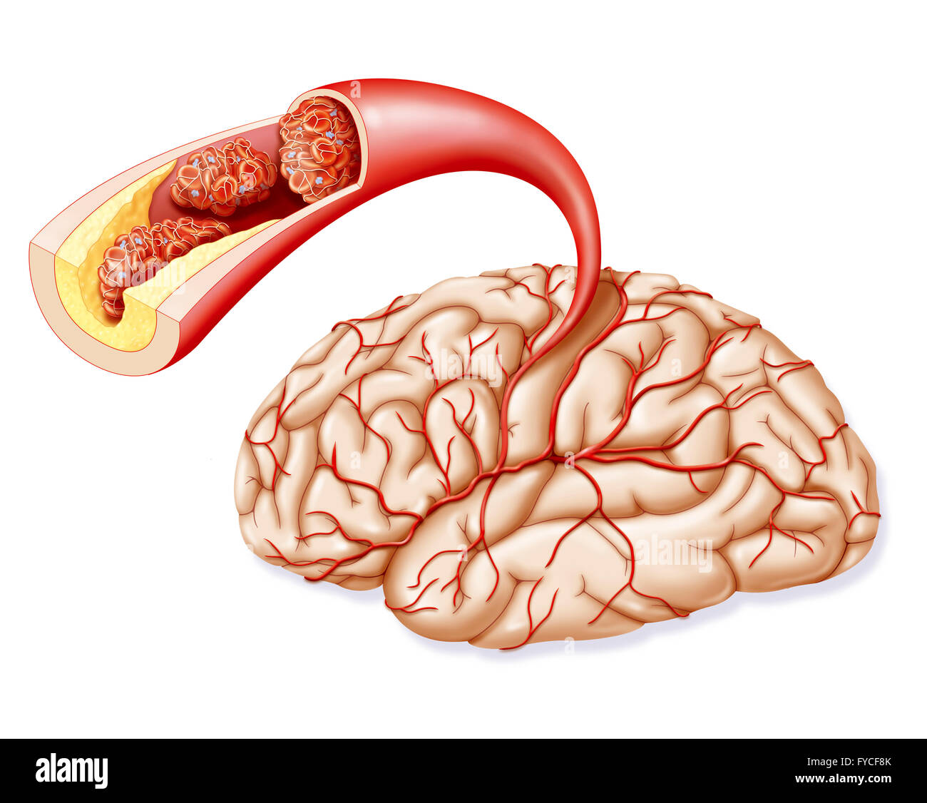 CEREBROVASCULAR ACCIDENT Stock Photo