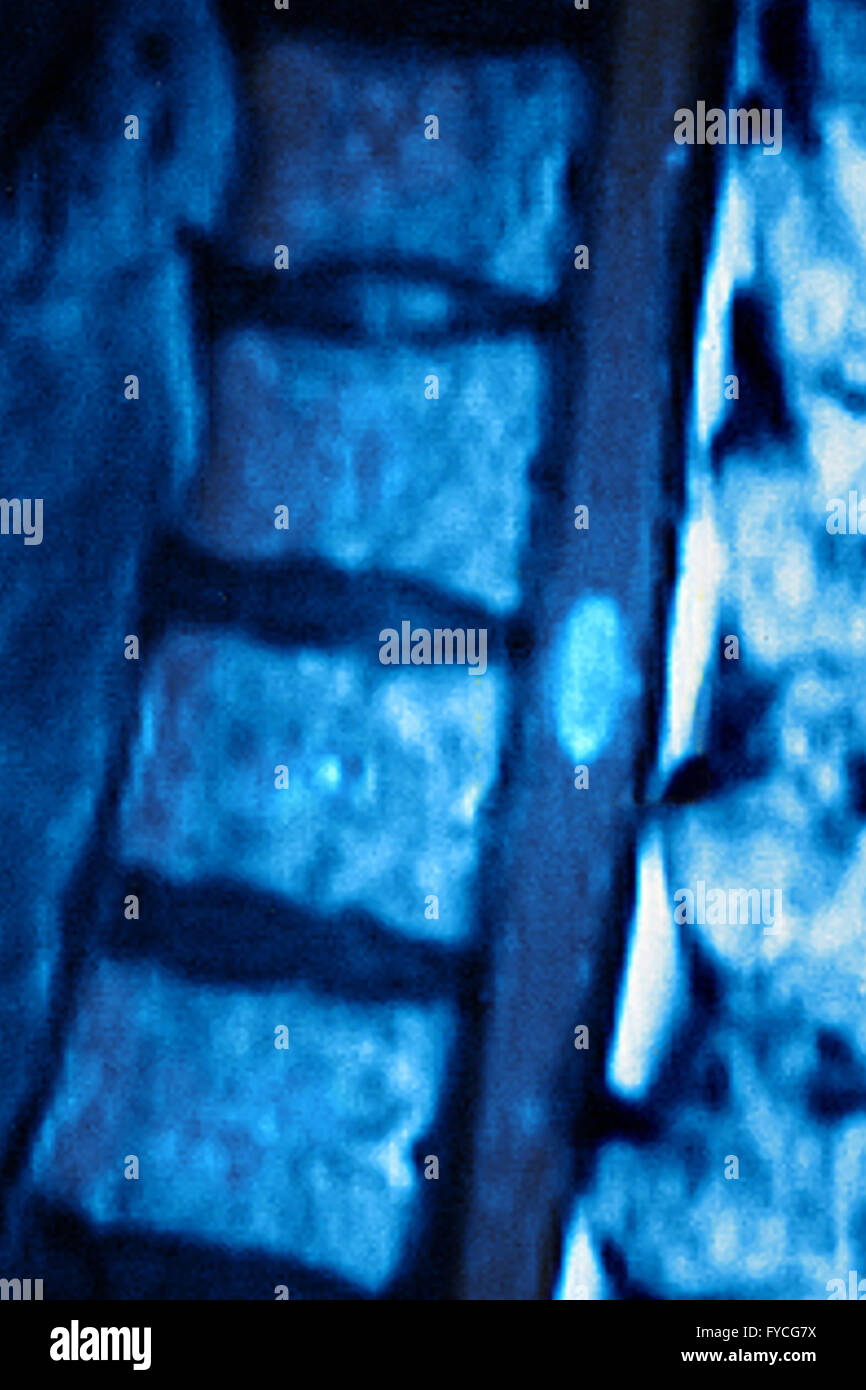 Mri Thoracic Spine High Resolution Stock Photography and Images - Alamy
