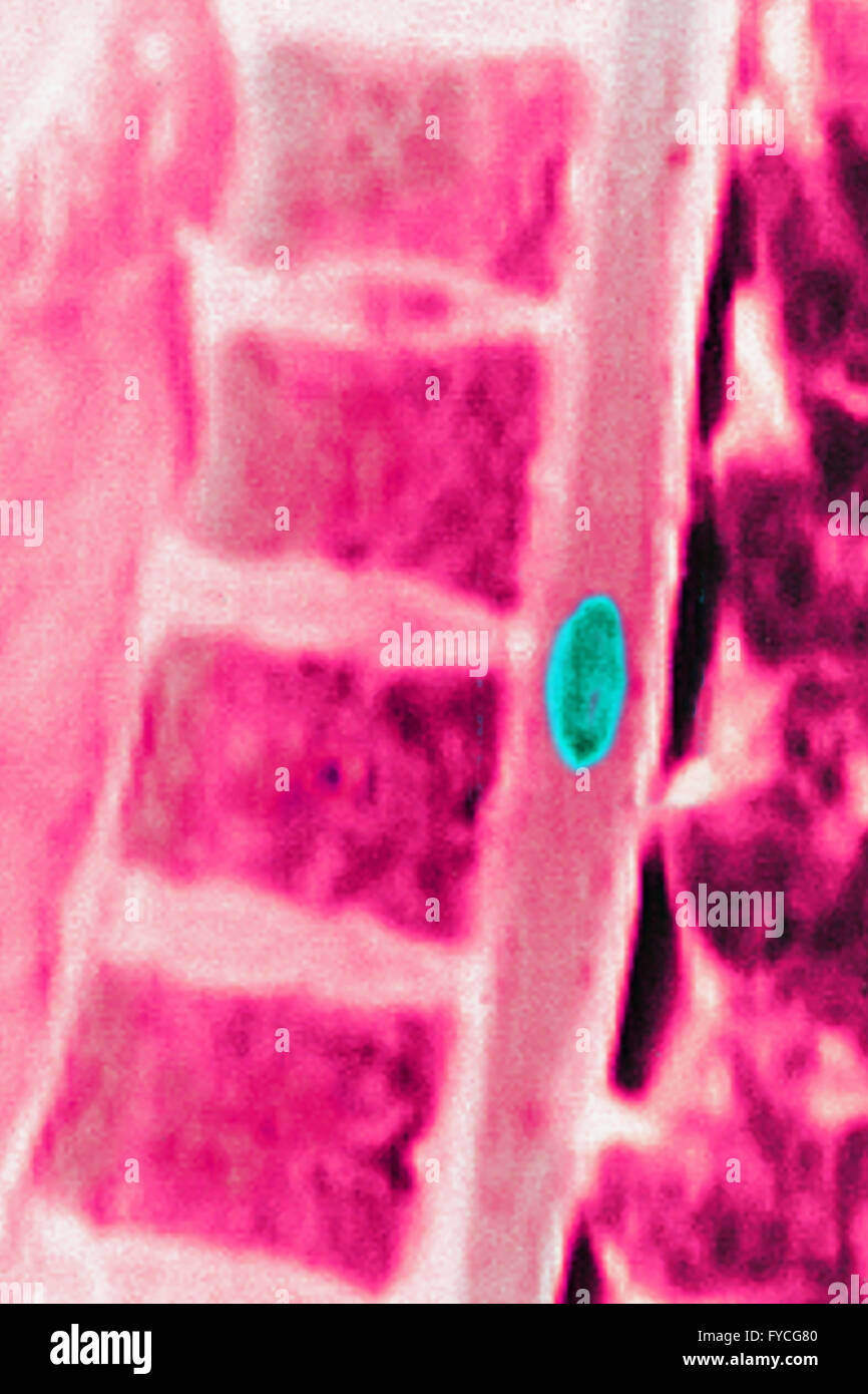 Mri Thoracic Spine High Resolution Stock Photography and Images - Alamy
