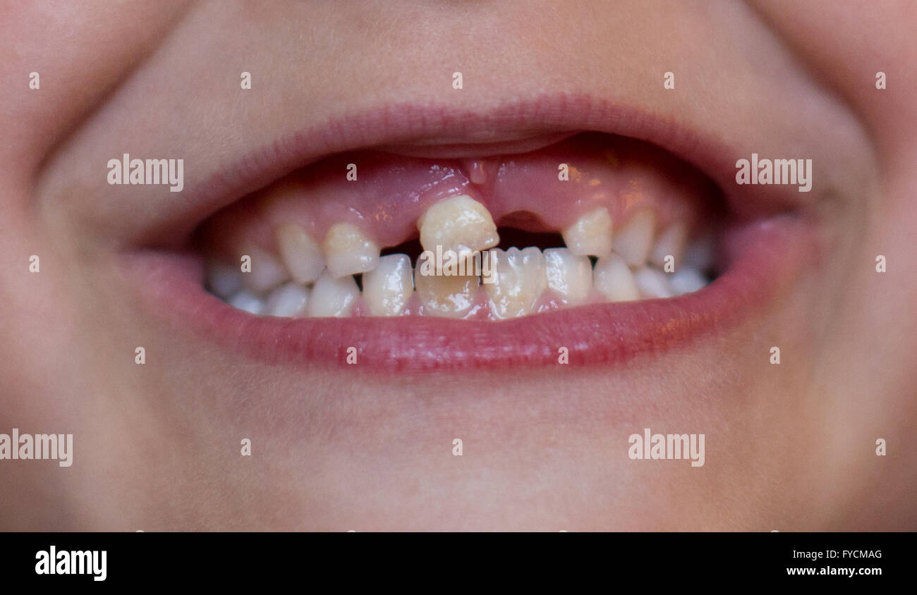A young girl smiles as she shows off her loose tooth Stock Photo