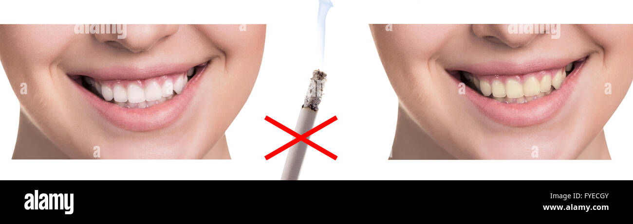 Smile before and after smoking. Stock Photo