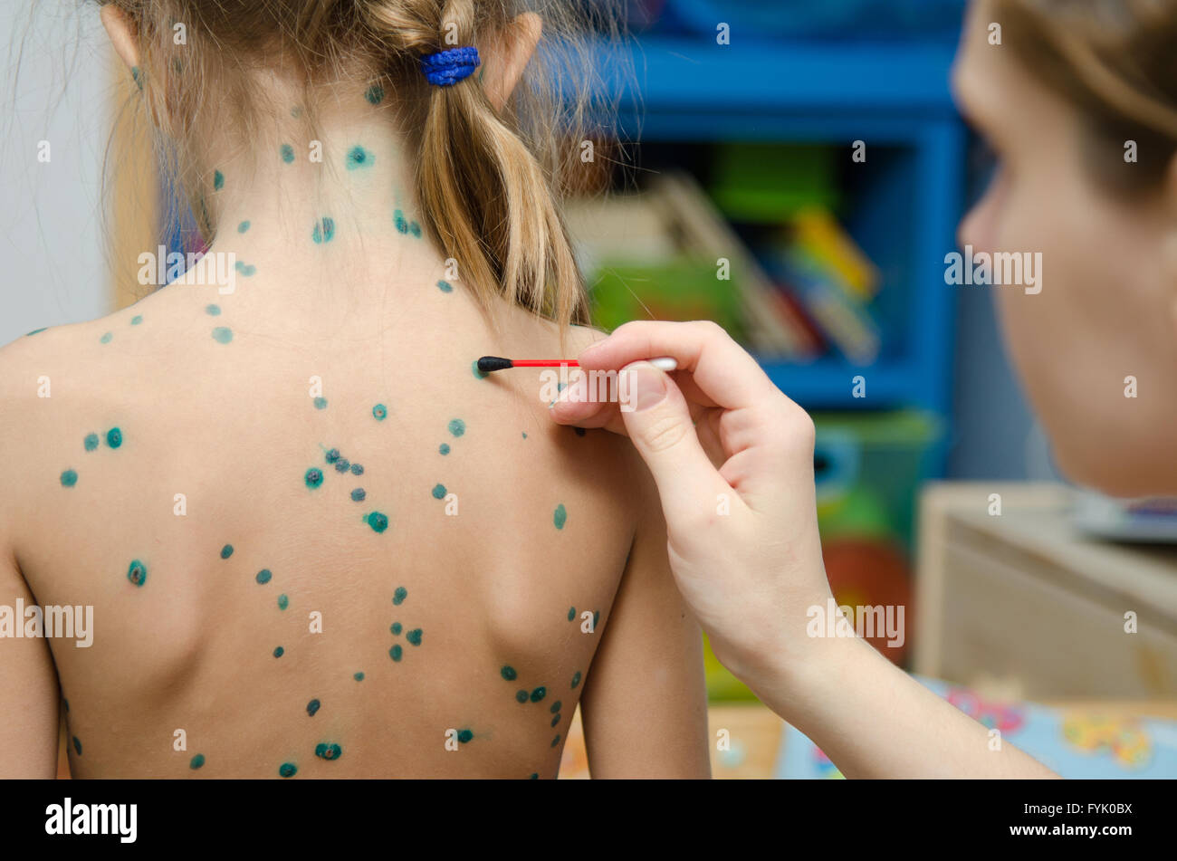 Lubrication zelenkoj chickenpox sores on back of a little girl Stock Photo