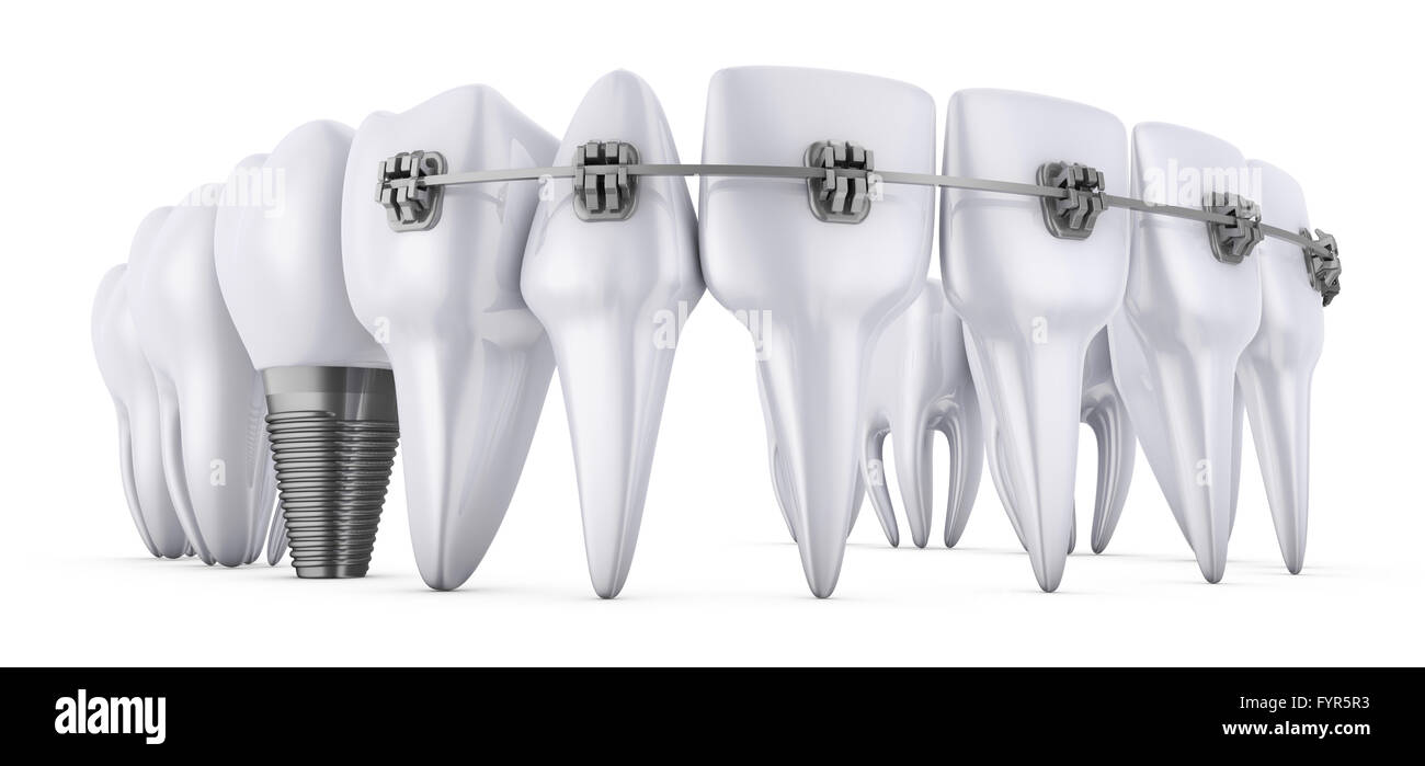 a teeth with braces and dental implants, 3d render Stock Photo - Alamy