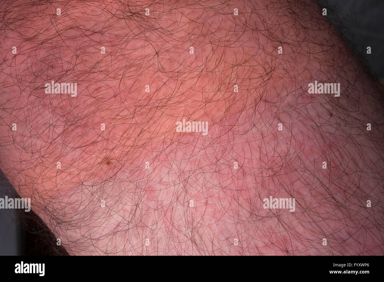 Urticaria on upper thigh of middle-aged man after outdoor exercise in cold 0°C temperature (clothing thinner on upper leg) Stock Photo