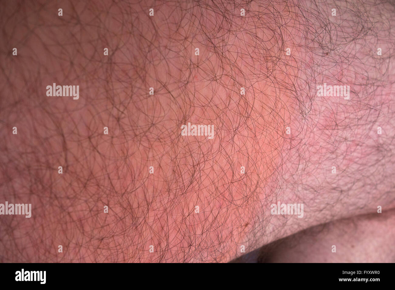 Urticaria on upper thigh of middle-aged man after outdoor exercise in cold 0°C temperature (clothing thinner on upper leg) Stock Photo