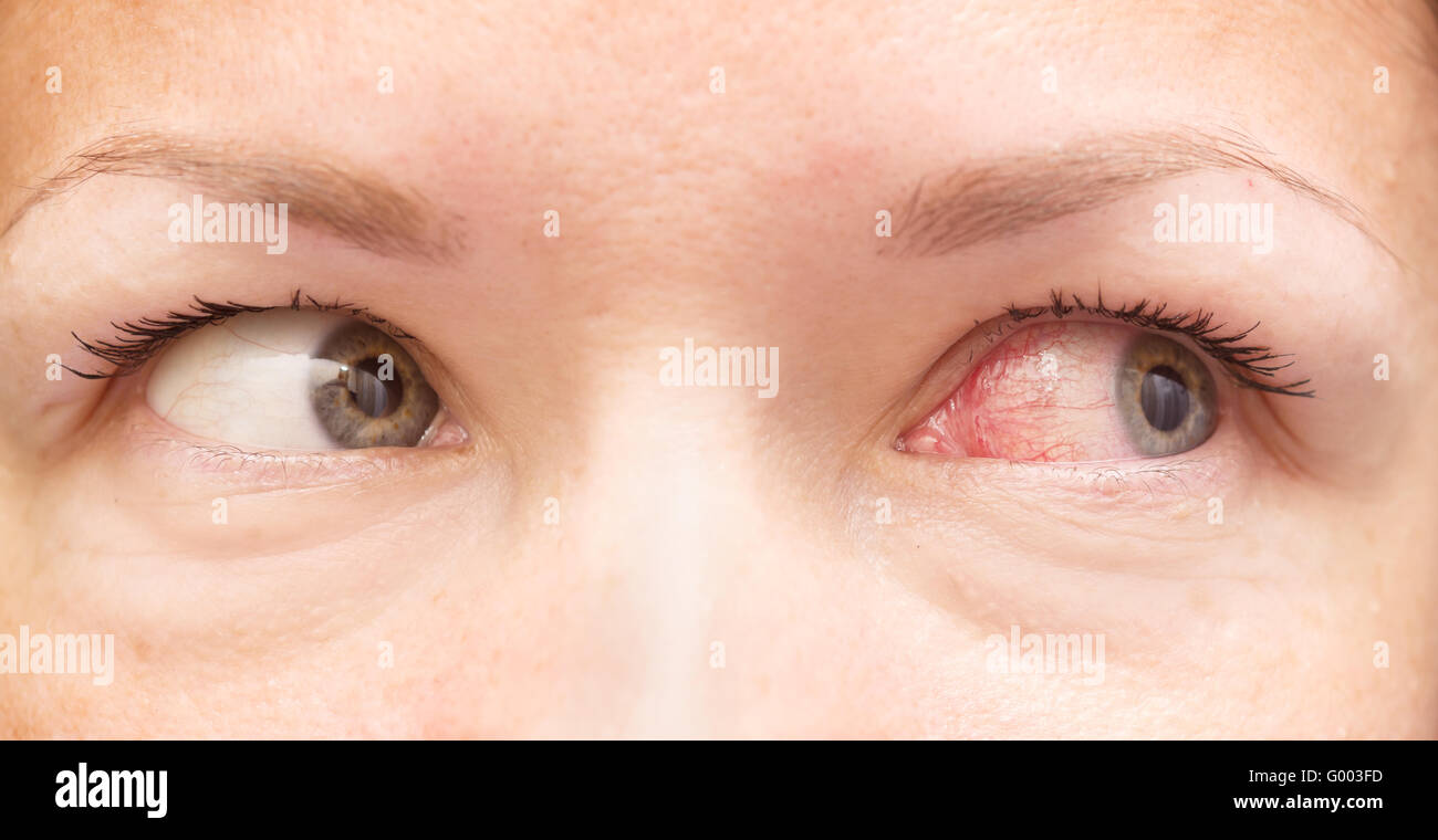 healthy and irritated eye Stock Photo Alamy
