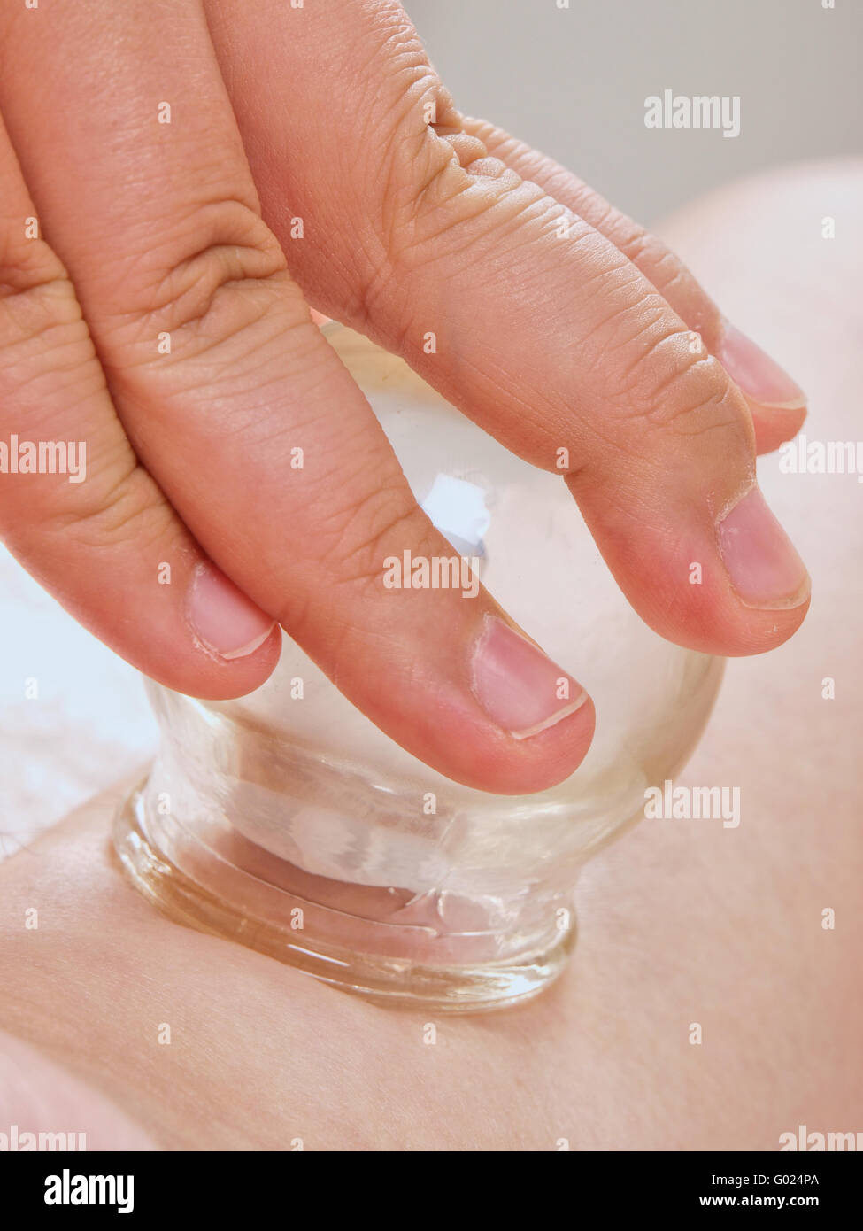 Traditional Chinese Cupping Stock Photo Alamy