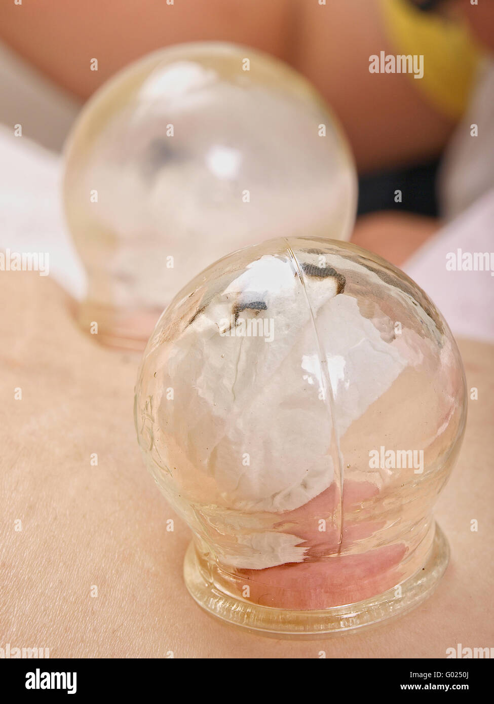 Traditional Chinese Cupping Stock Photo Alamy