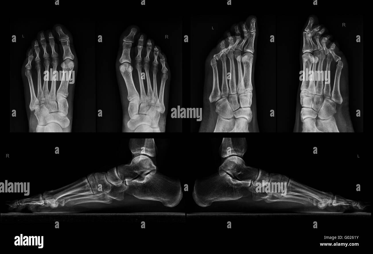 X-ray of both feet in three projections Stock Photo - Alamy