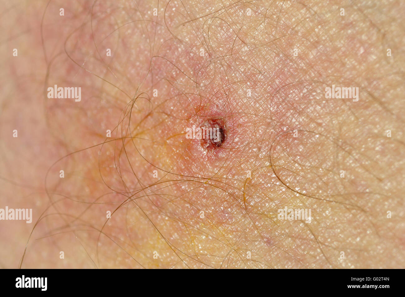 infected tick bite infected tick bite