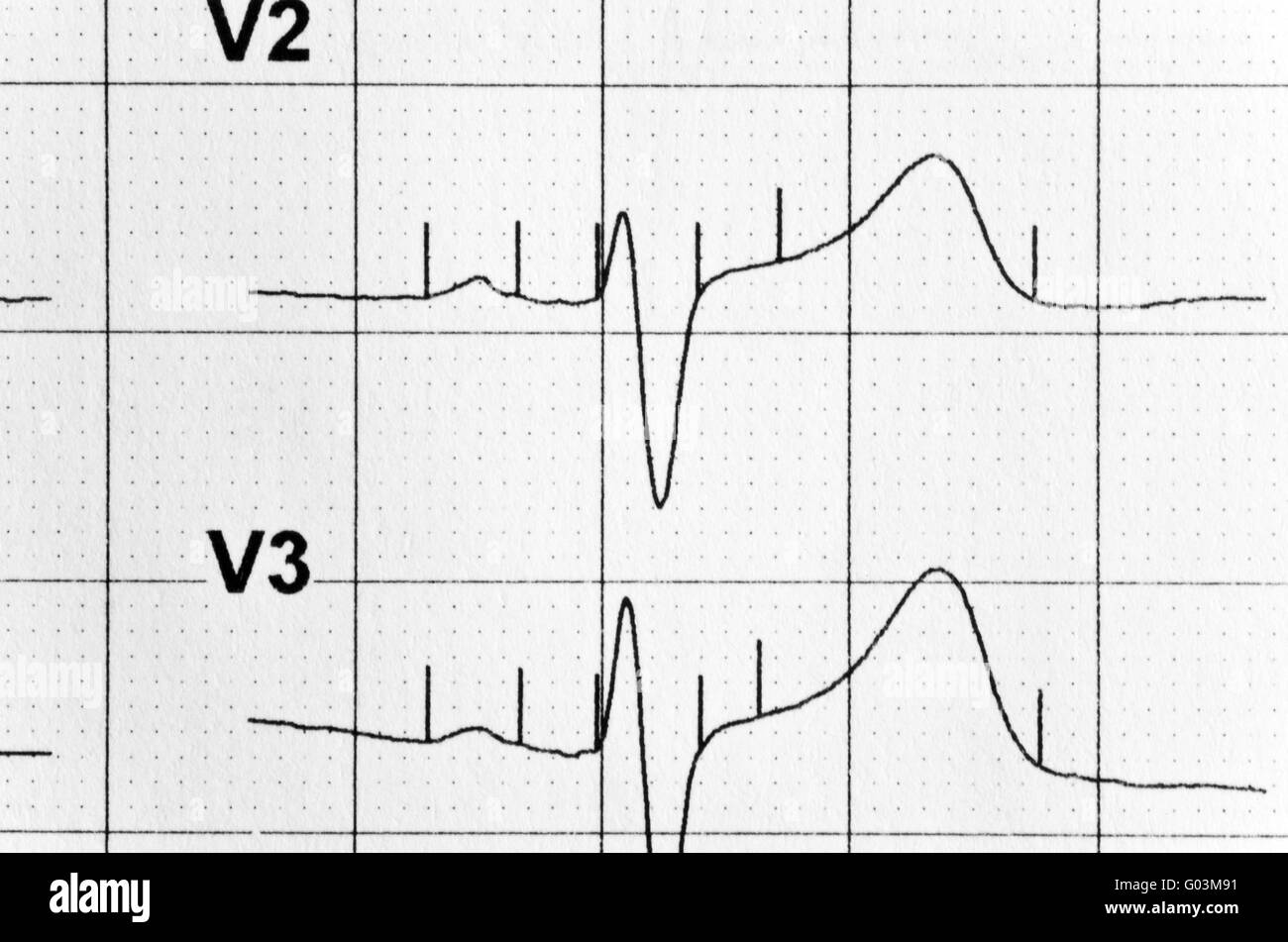 schedule of heart rate drawn by the modern medical Stock Photo