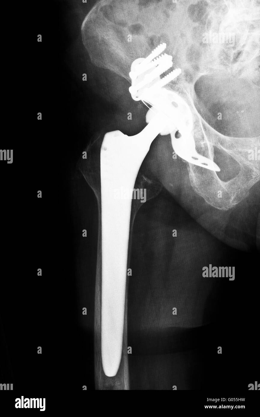 Artificial hip joint Stock Photo