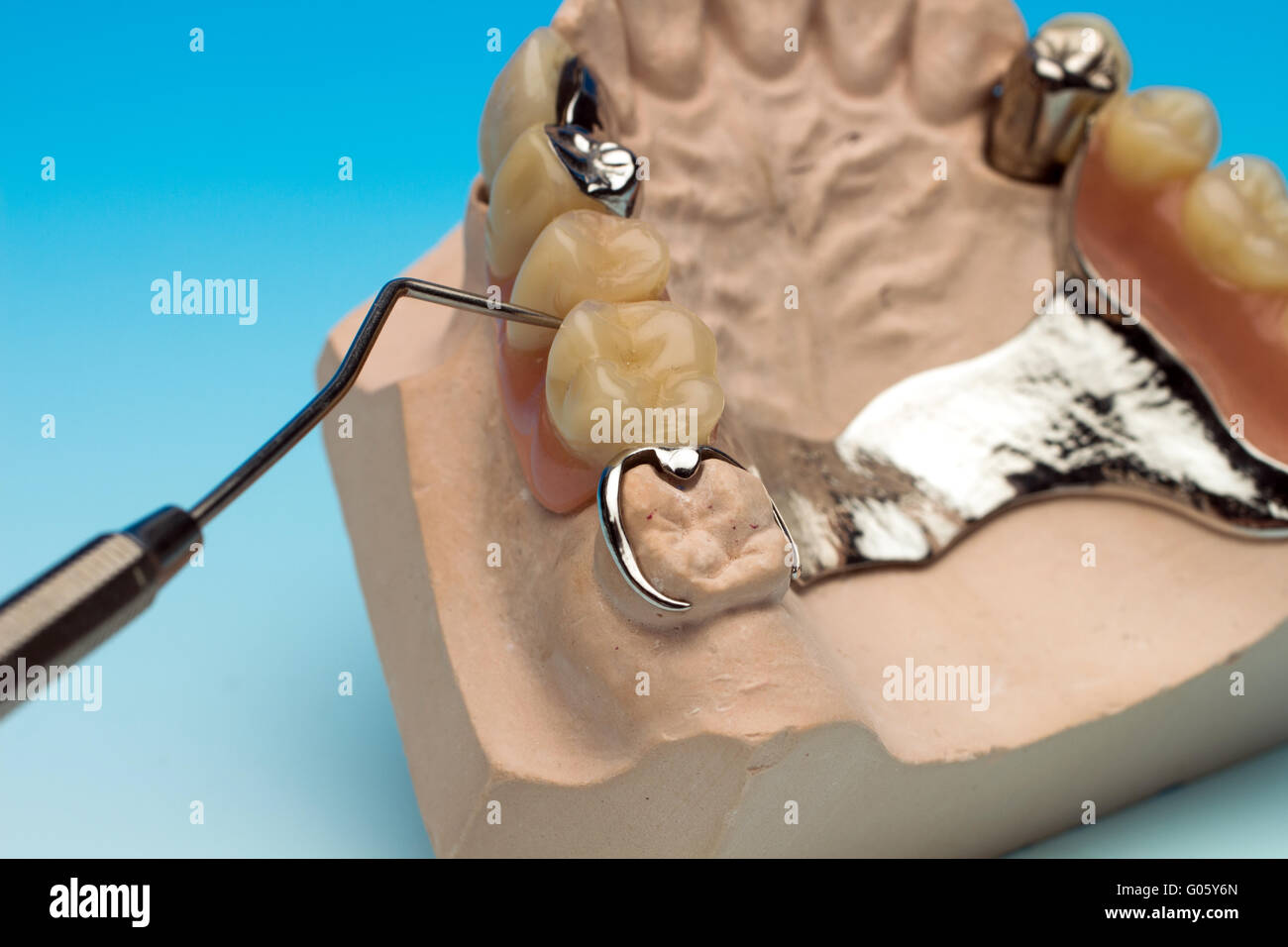 Plaster cast with dental bridge and probe Stock Photo